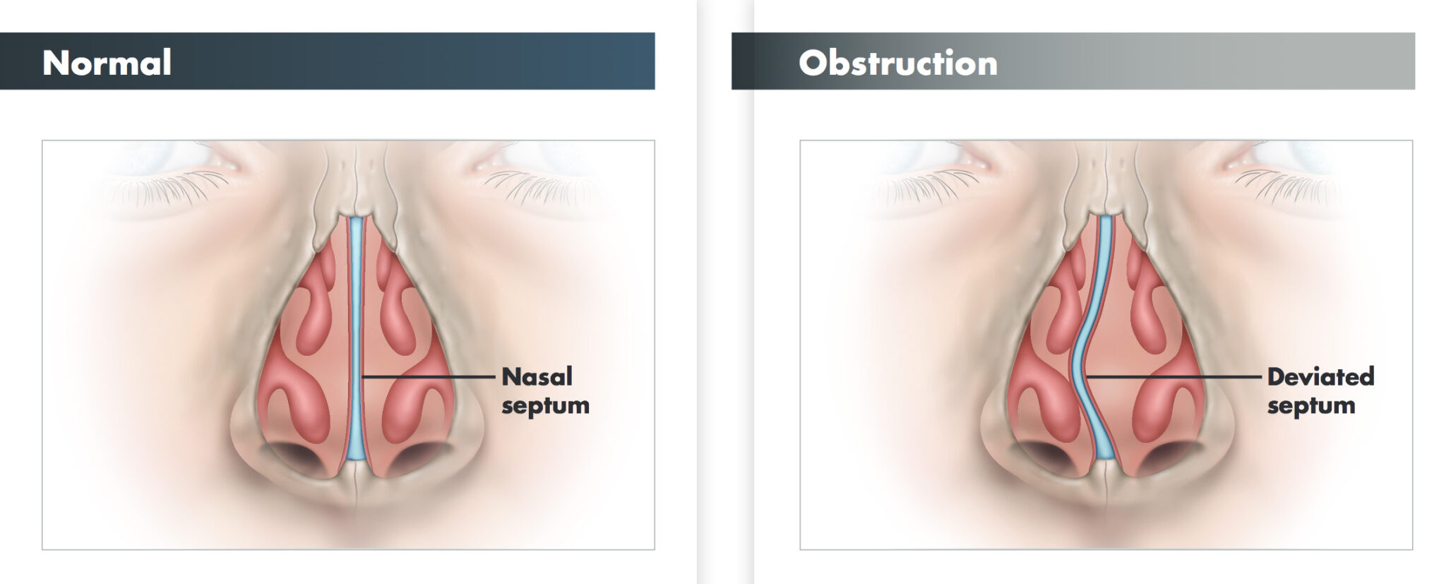 Septoplasty In Spring TX Texas Sinus Snoring