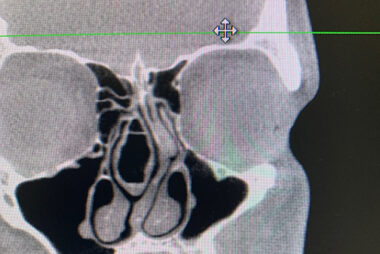 CT scan concha bullosa enlarged turbinates turbinate reduction