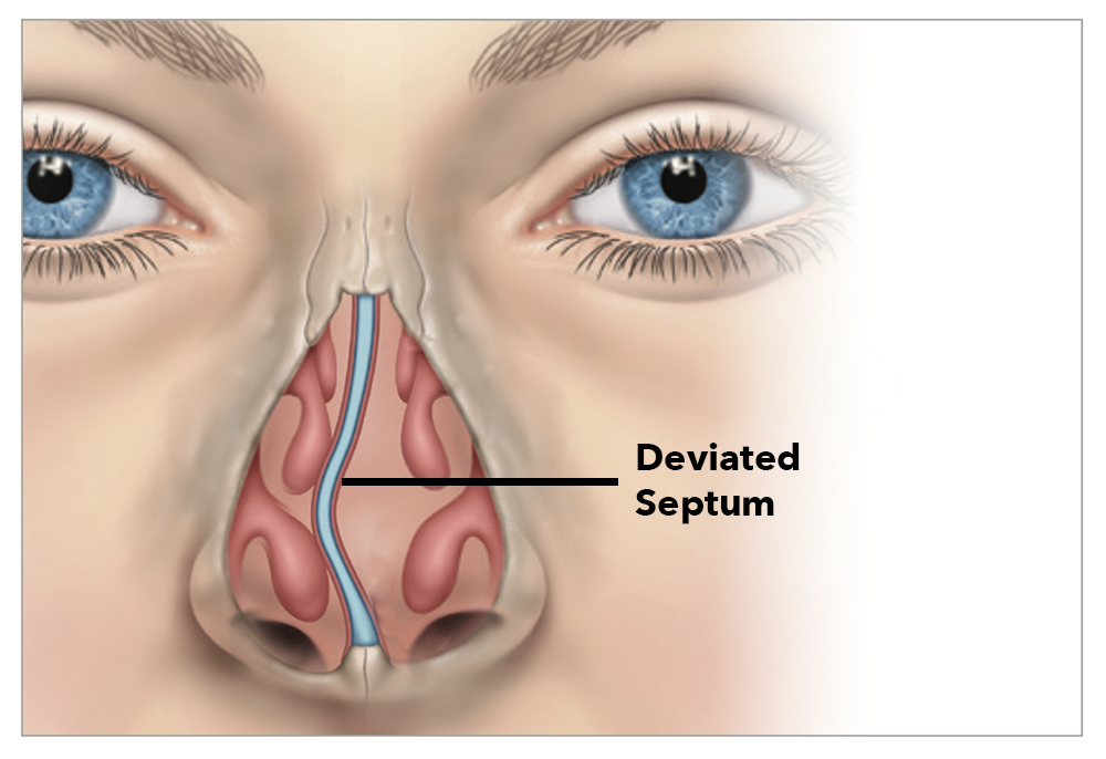 Septoplasty at Texas Sinus and Snoring Spring Houston TX stuffy nose Deviated Septum