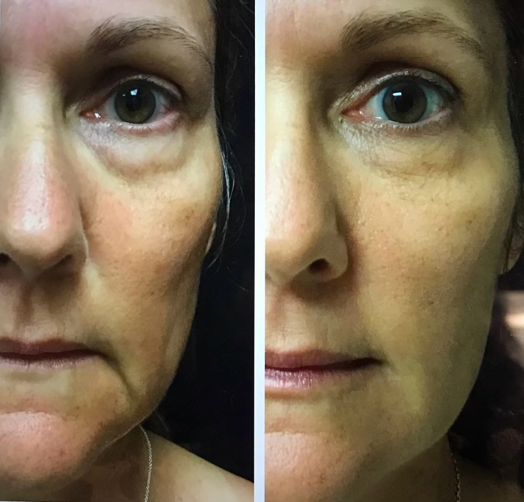 Before & After non-surgical cosmetic treatments