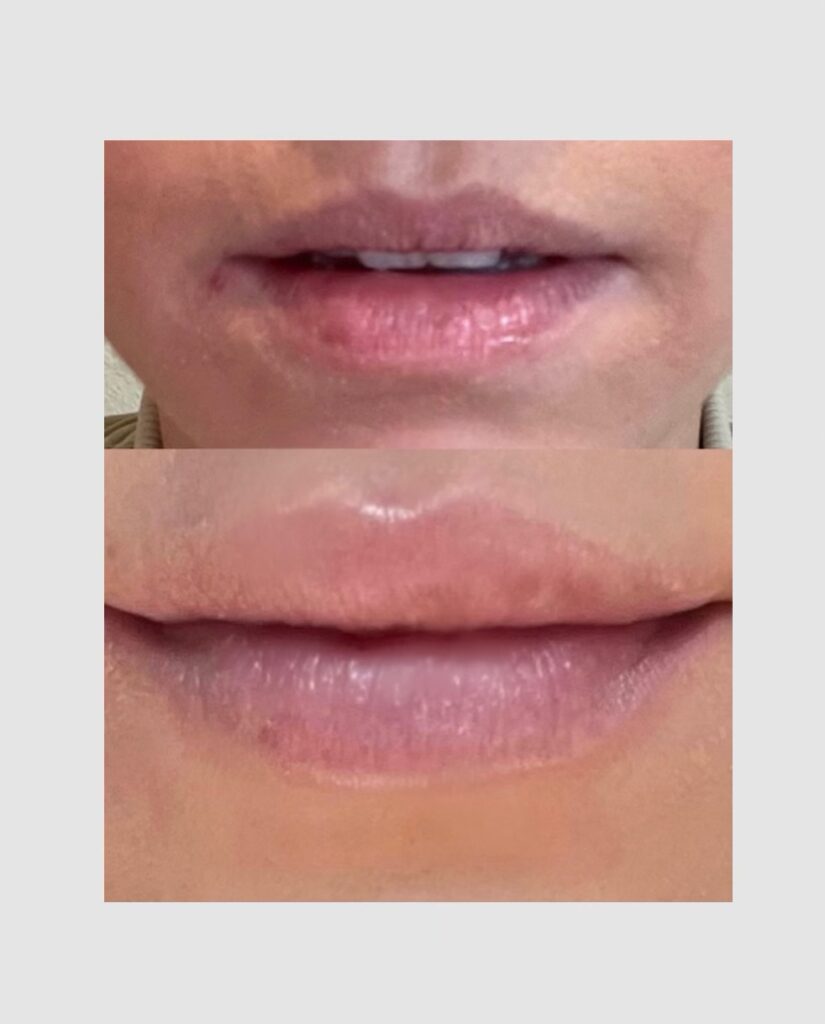 Before & After non-surgical cosmetic treatments 