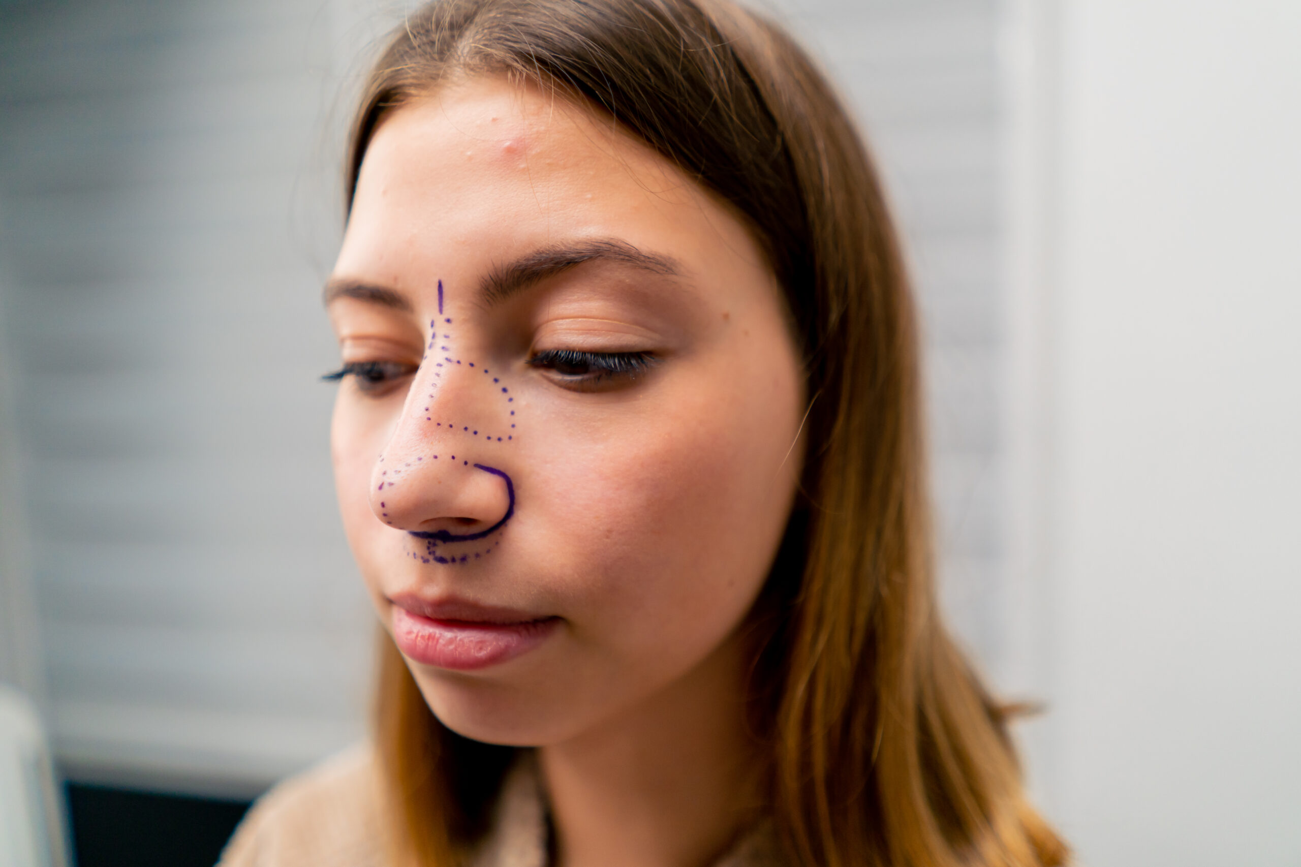 Best Rhinoplasty Surgery Guide