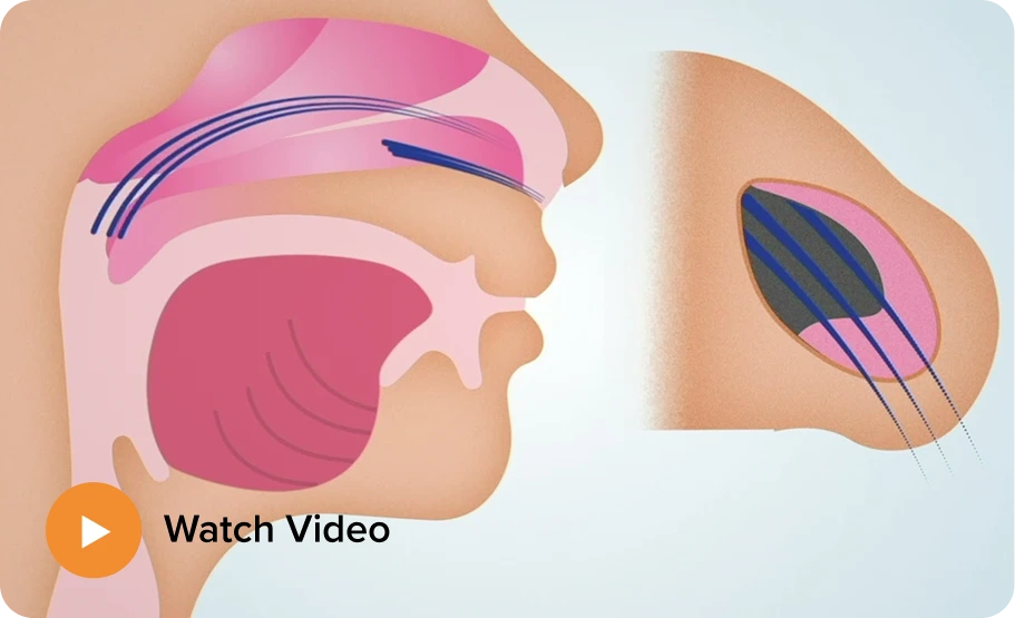 Balloon Sinuplasty Snoring Houston, TX Banner