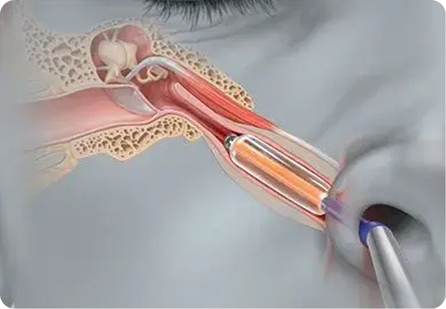 Eustachian Tube Dilation in Houston, TX Banner