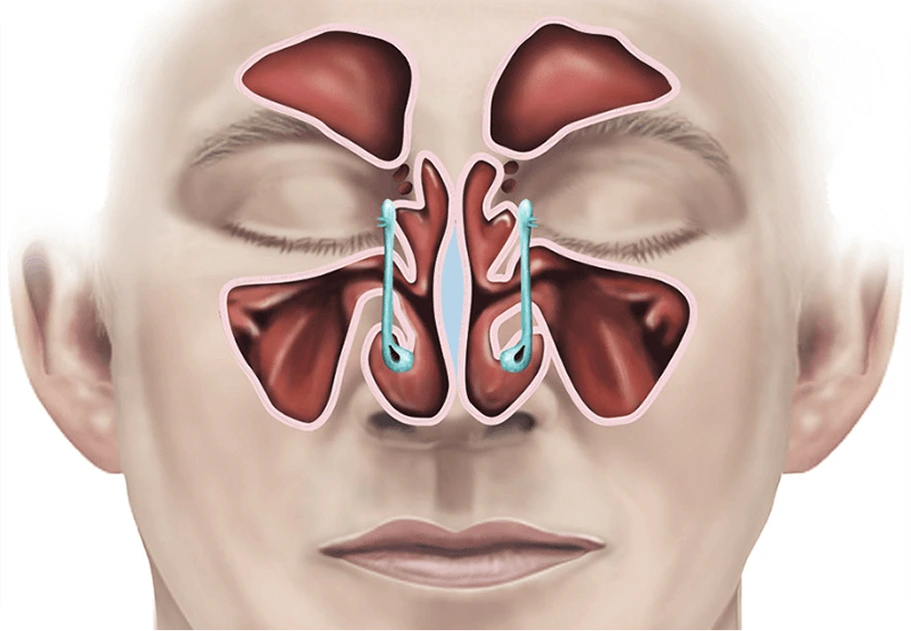Functional Endoscopic Sinus Surgery (FESS) in Houston, TX Banner