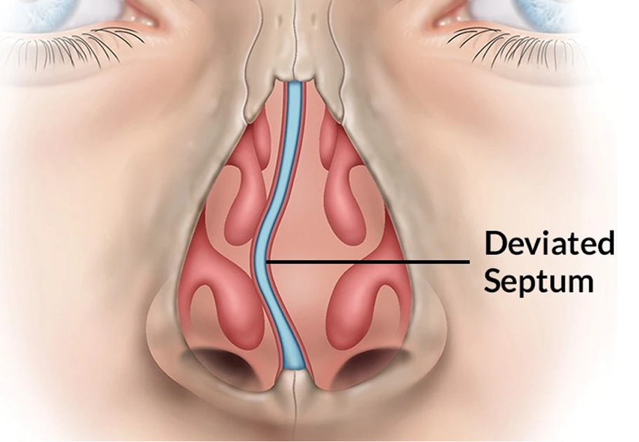 Septoplasty in Houston, TX Banner