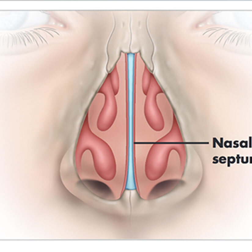 Septoplasty Houston Deviated Septum